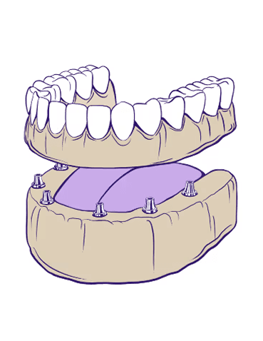 Full Mouth Dental Implants