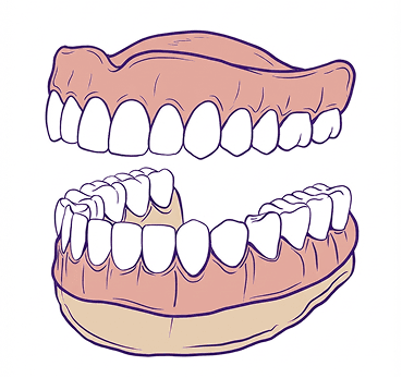 Implant Supported Dentures