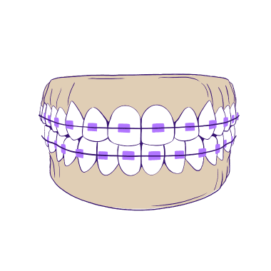 5 Main Types of Braces Available/Kalyani Nagar, by Jadhav Meenakshi