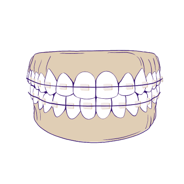 ceramic braces