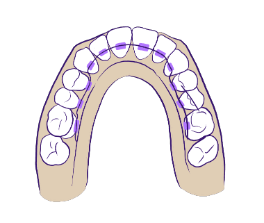 Lingual braces