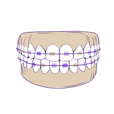 self ligating braces