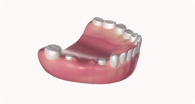 preparing abutment teeth