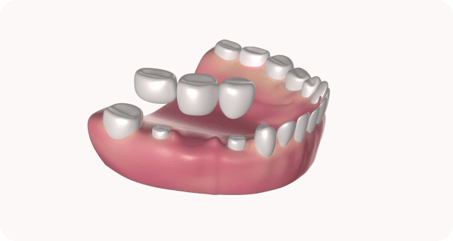 dental bridge construction