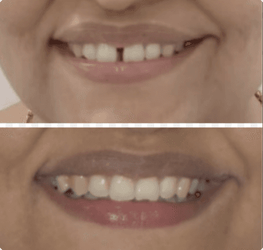 teeth gap before & after aligner