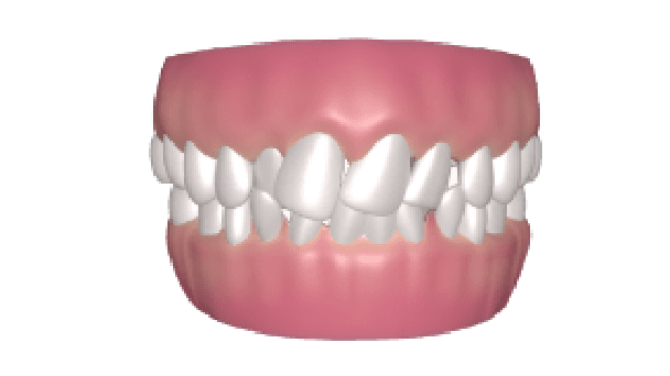 crowded teeth condition