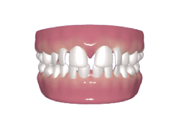 teeth gap condition