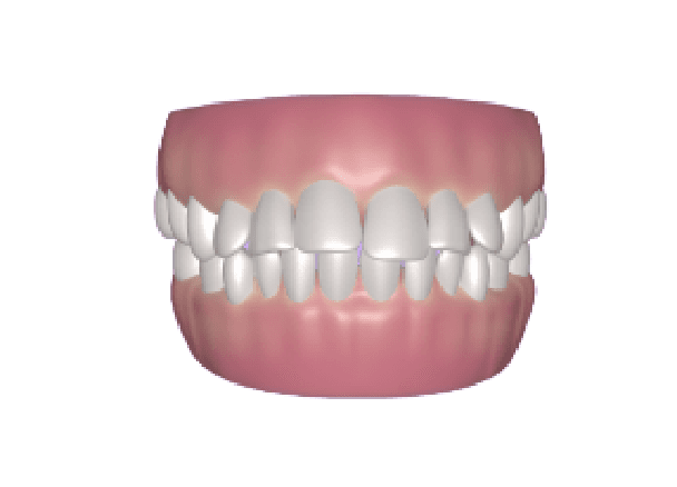 overbite forwardly placed teeth condition