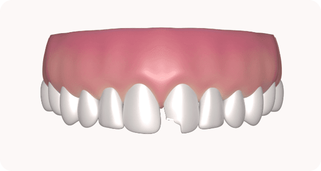 preparing the tooth