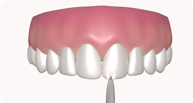 shaping composite tooth