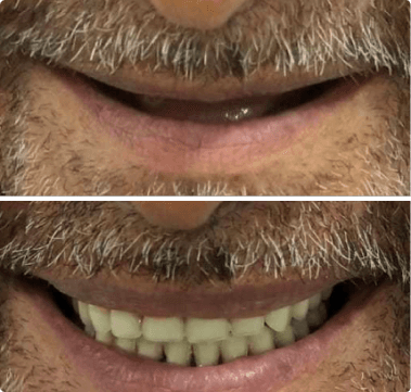 Dental Implant before and after treatment