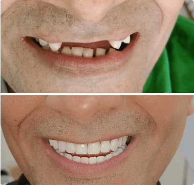 before and after Dental Implant images