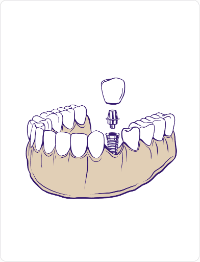 single tooth Dental Implant treatment