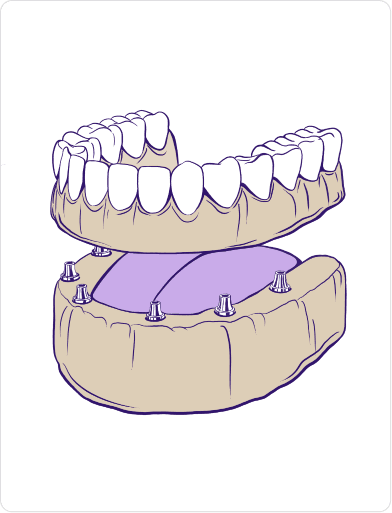 full mouth dental Implants treatment