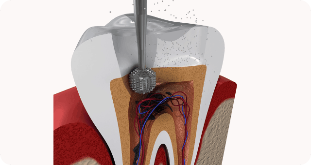 drilling and opening tooth