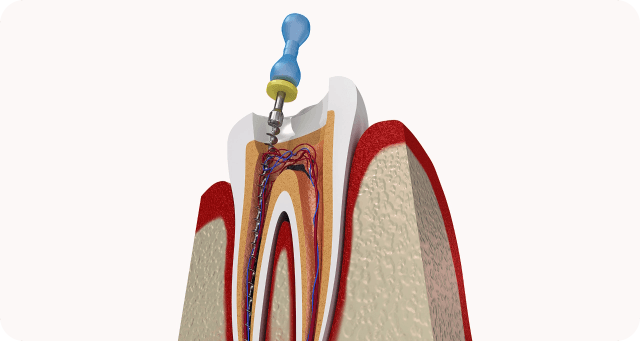 shaping and filling the tooth