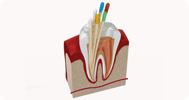 finishing root canal