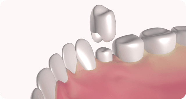 Adding dental crown