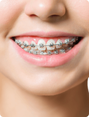 metal braces