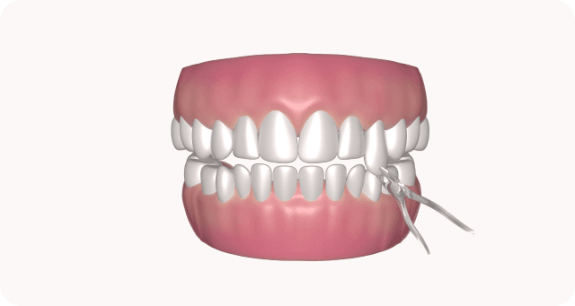 tooth extraction procedure