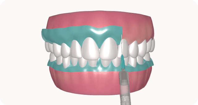 Lip and gum protection with retractor