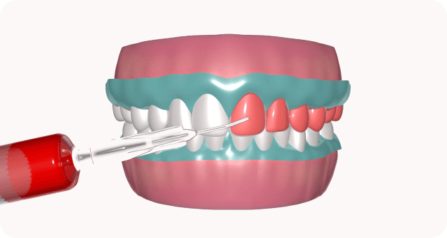 Teeth whitening application