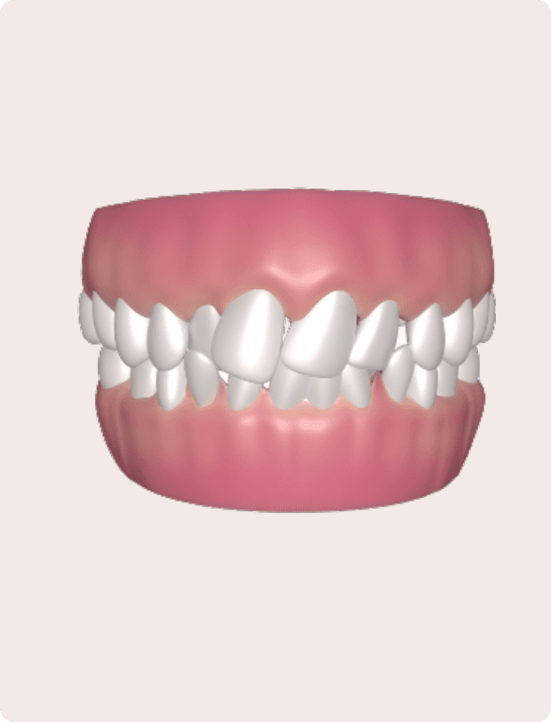 Crowded teeth