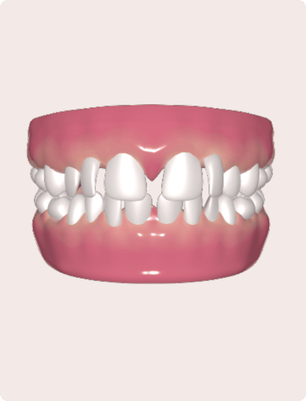 Teeth Gap