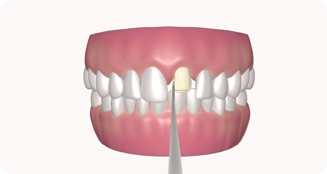 preparation for veneer teeth