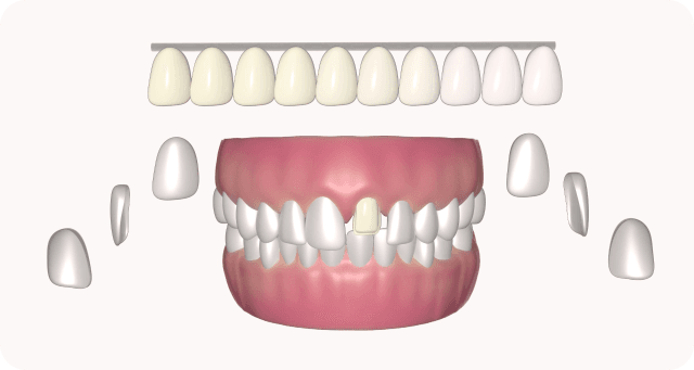 fabrication of veneers