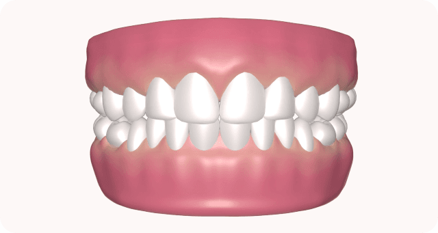 veneer teeth bonding