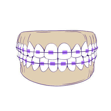Traditional metal braces