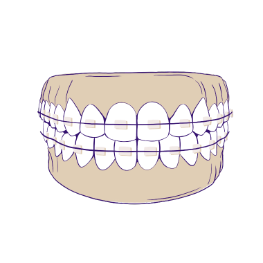 ceramic braces