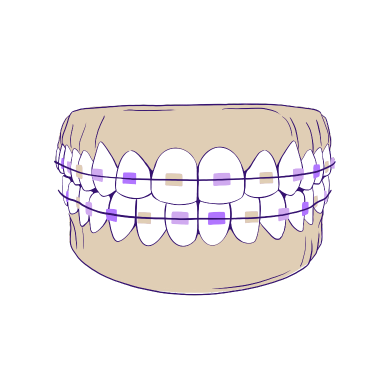self ligating braces