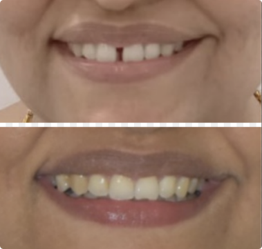 teeth gap before & after aligner