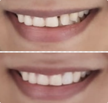teeth gap before & after invisible braces