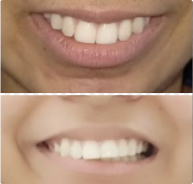 before and after invisible braces