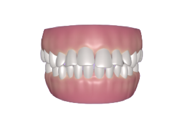 overbite forwardly placed teeth condition