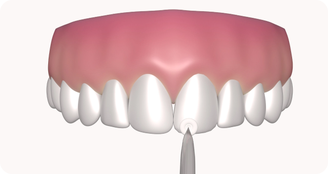 shaping composite tooth