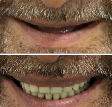 Dental Implant before and after treatment