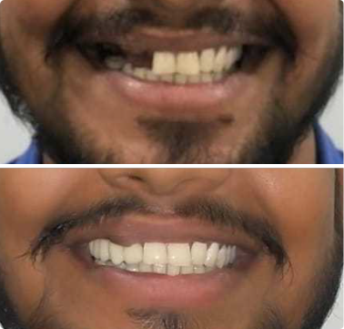 before and after Dental Implant treatment