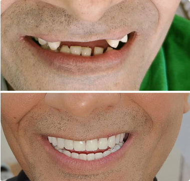 before and after Dental Implant images
