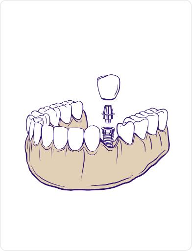 single tooth Dental Implant treatment
