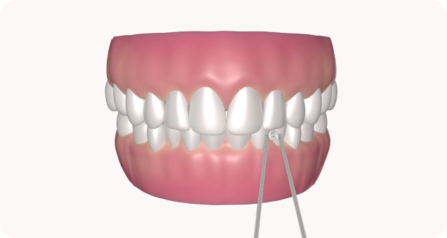 Jewellery gems placement on tooth