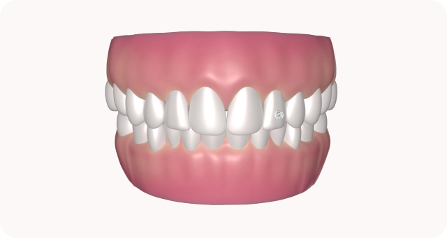 setting up jewel in tooth
