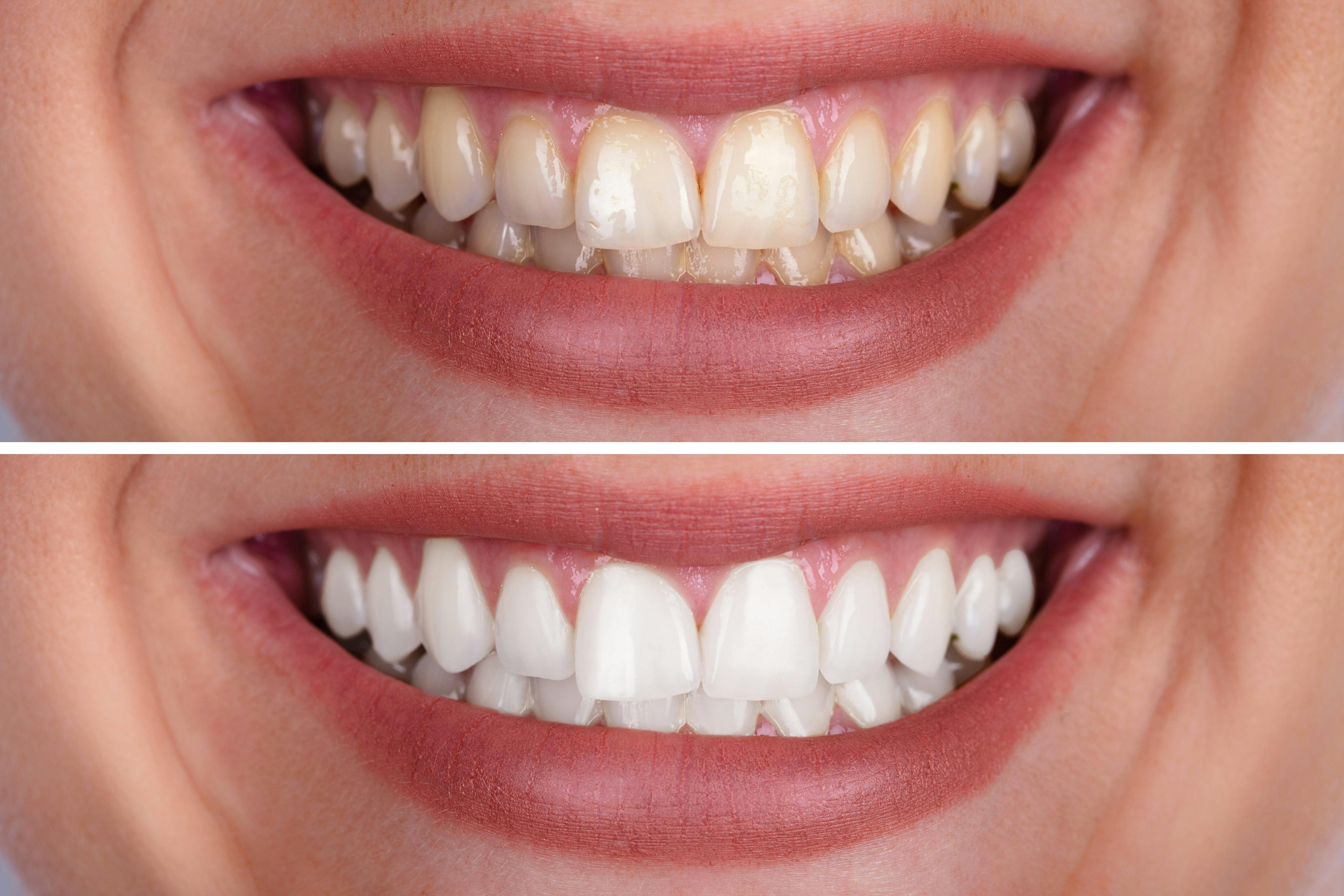 before and after teeth whitening picture