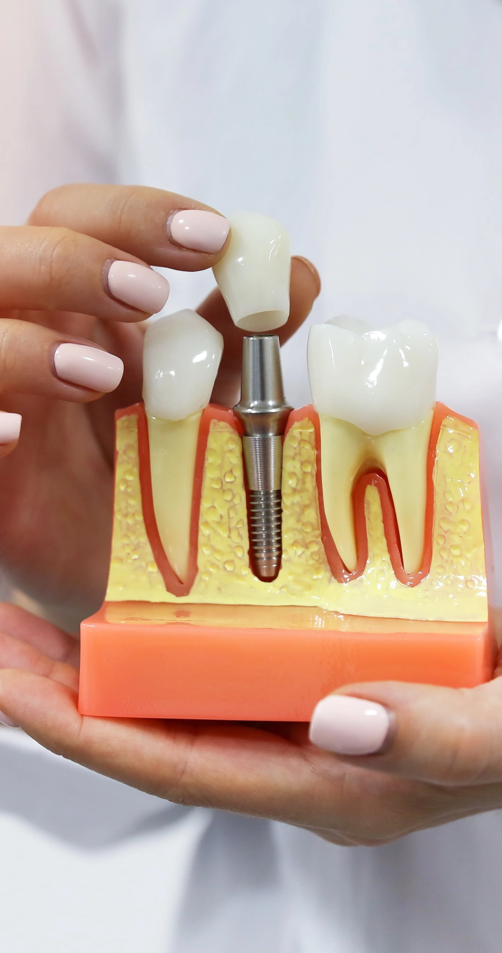 dental implants benefits at Dezy