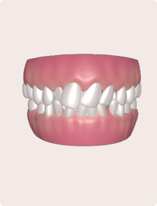 Freed Teeth Problem Overbite (protrude) Teeth: Causes, Risks, and Treatment - Dezy