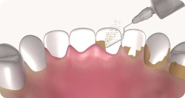 teeth scaling